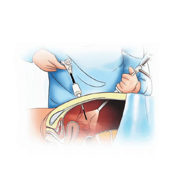 Minimal Invasive Surgery - Gynecology