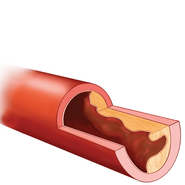 Certificate in Hypertension Management