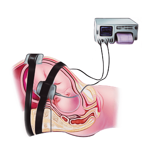 Electronic Fetal Monitoring